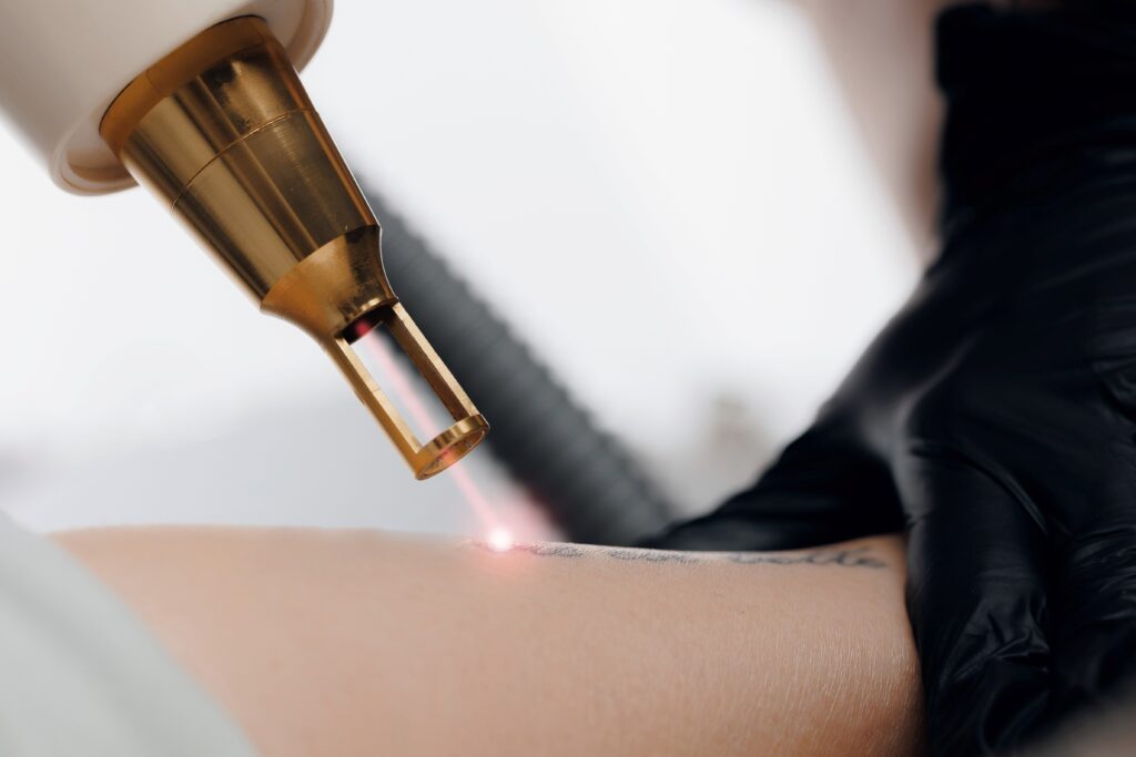Tattoo Weglasern_eraesthetic.de