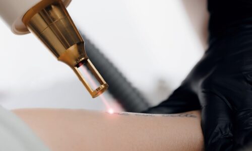 Wenn alte Tattoos zur Last werden – Wege zu einem neuen Hautgefühl